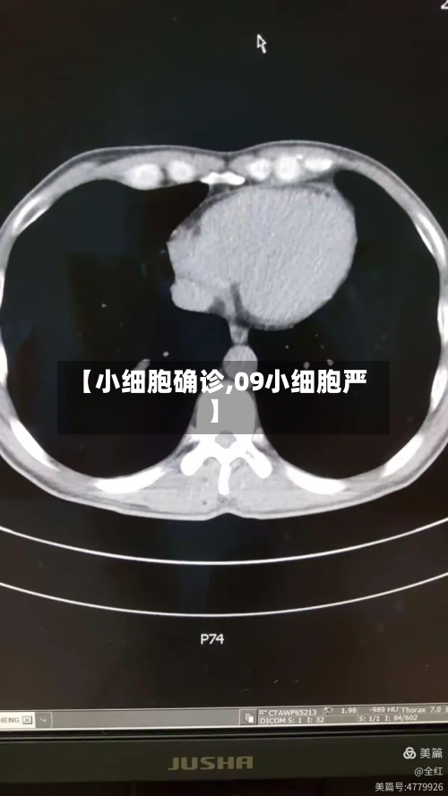 【小细胞确诊,09小细胞严】