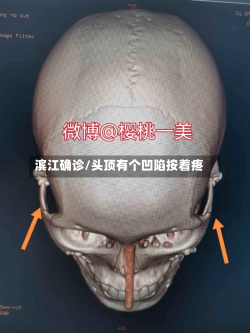 滨江确诊/头顶有个凹陷按着疼