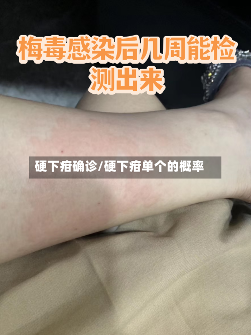 硬下疳确诊/硬下疳单个的概率-第3张图片