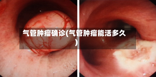 气管肿瘤确诊(气管肿瘤能活多久)