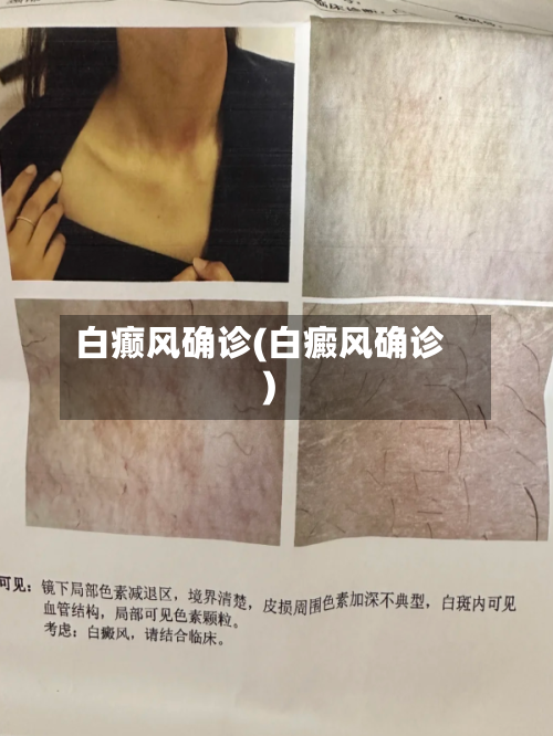 白癫风确诊(白癜风确诊)-第3张图片