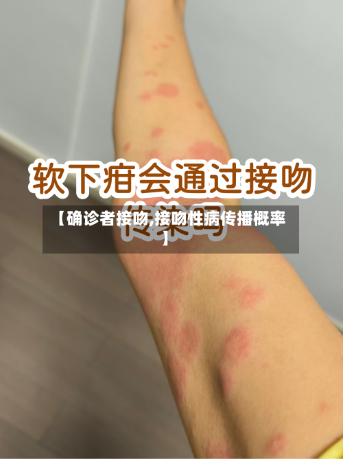 【确诊者接吻,接吻性病传播概率】-第2张图片