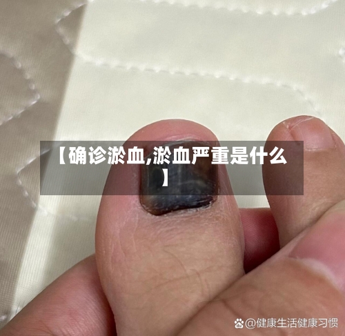 【确诊淤血,淤血严重是什么】